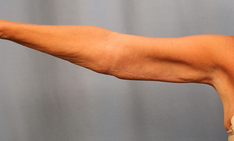 Brachioplasty Before & After