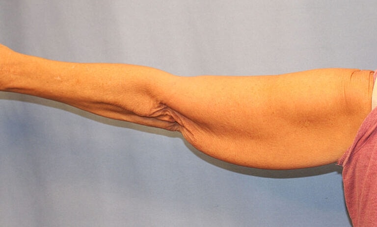 Brachioplasty Before & After