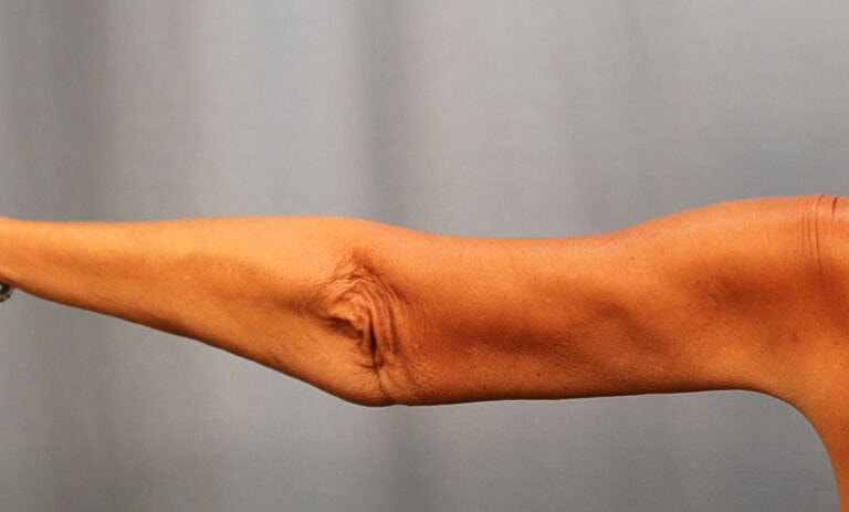 Brachioplasty Before & After