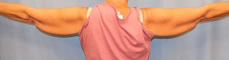 Brachioplasty Before & After