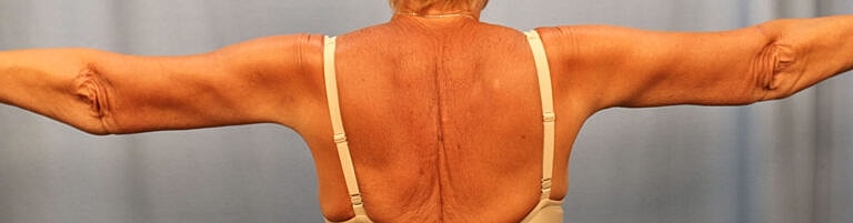 Brachioplasty Before & After