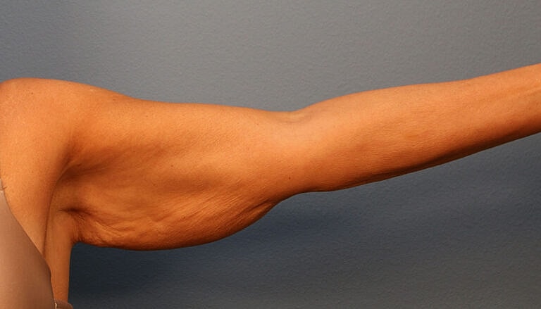 Brachioplasty Before & After