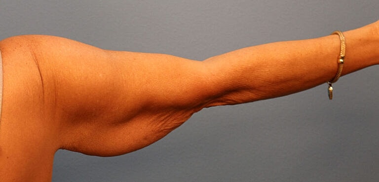Brachioplasty Before & After