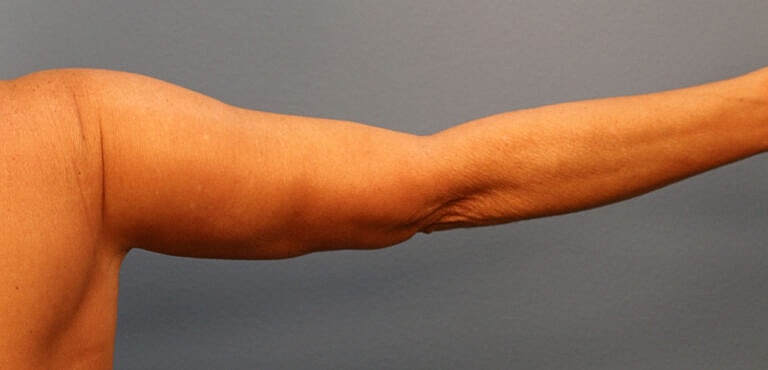 Brachioplasty Before & After