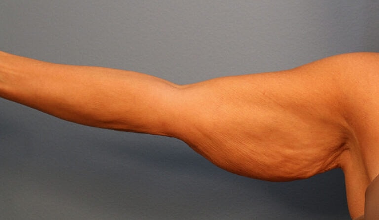 Brachioplasty Before & After