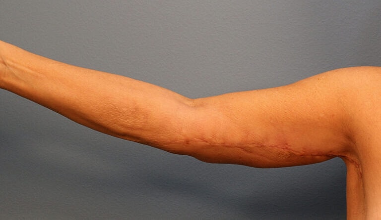 Brachioplasty Before & After
