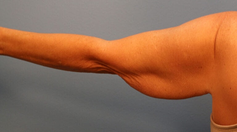 Brachioplasty Before & After