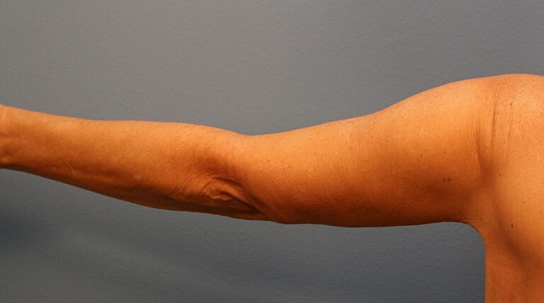 Brachioplasty Before & After